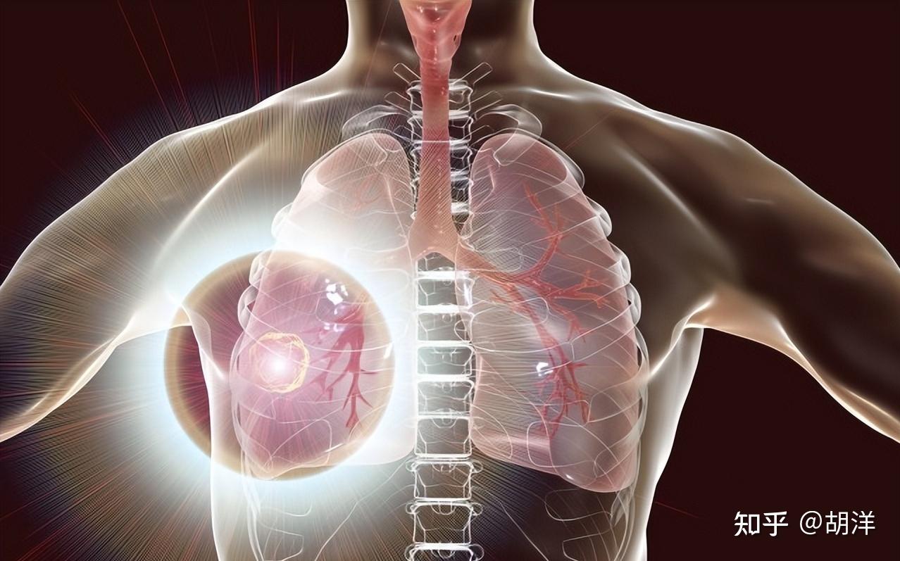 肺癌有哪些分型？肺癌细胞的行为跟正常细胞有什么不一样？ - 知乎
