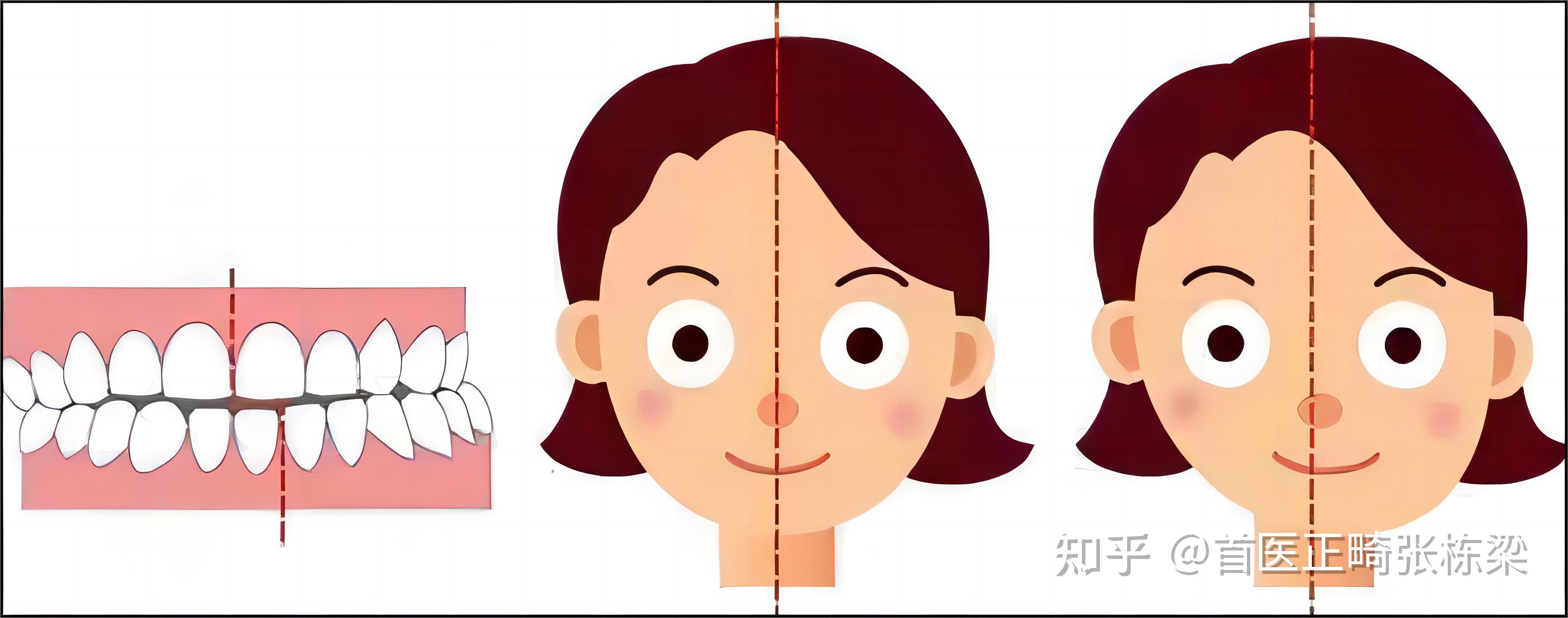 偏颌什么程度才要正颌手术? - 知乎