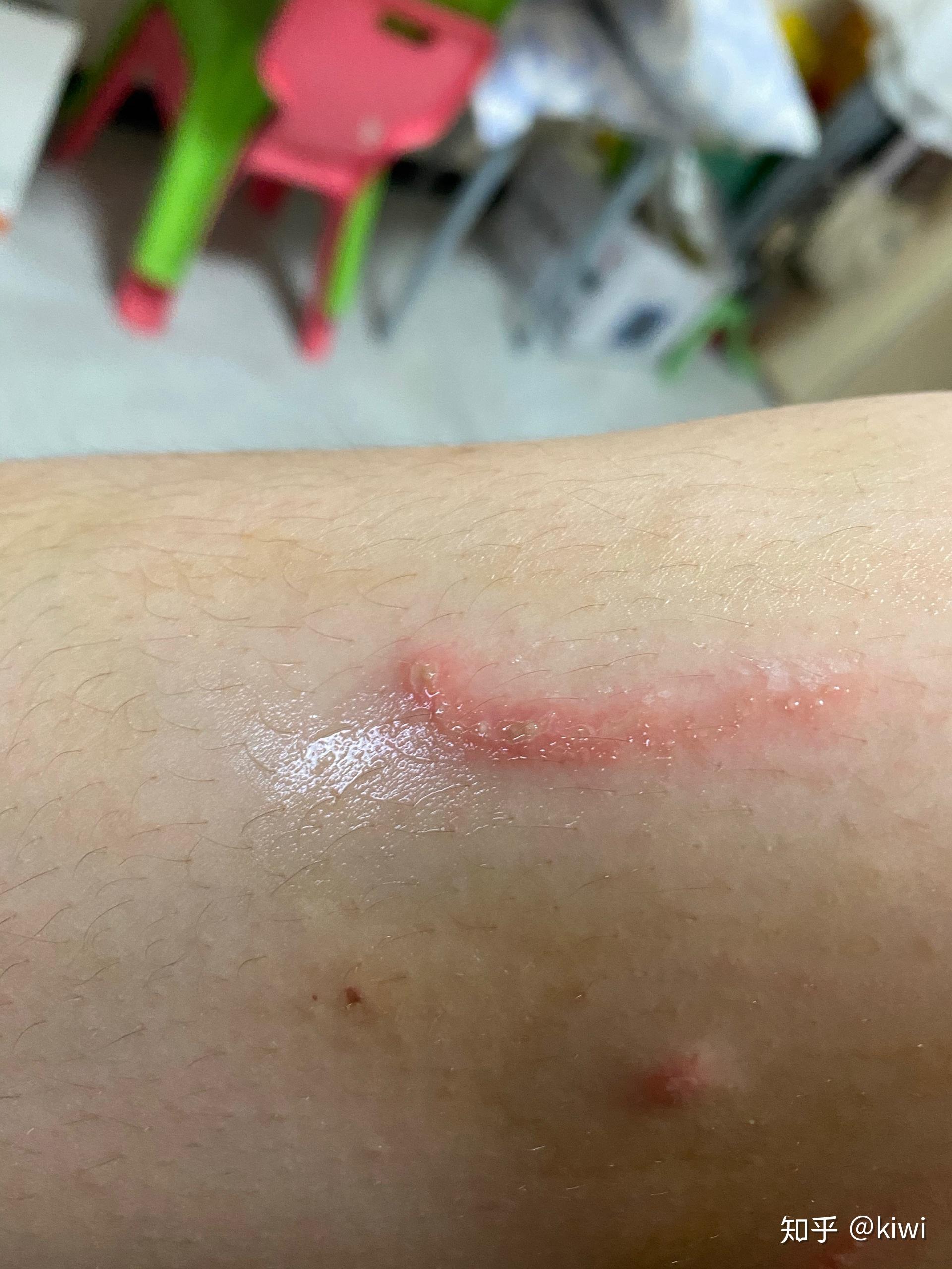 被隐翅虫咬了会怎么样? - 知乎