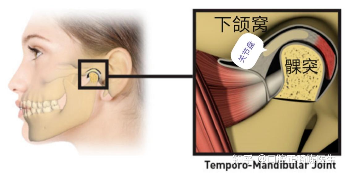 有深覆合做了牙齒矯正是一種什麼樣的體驗