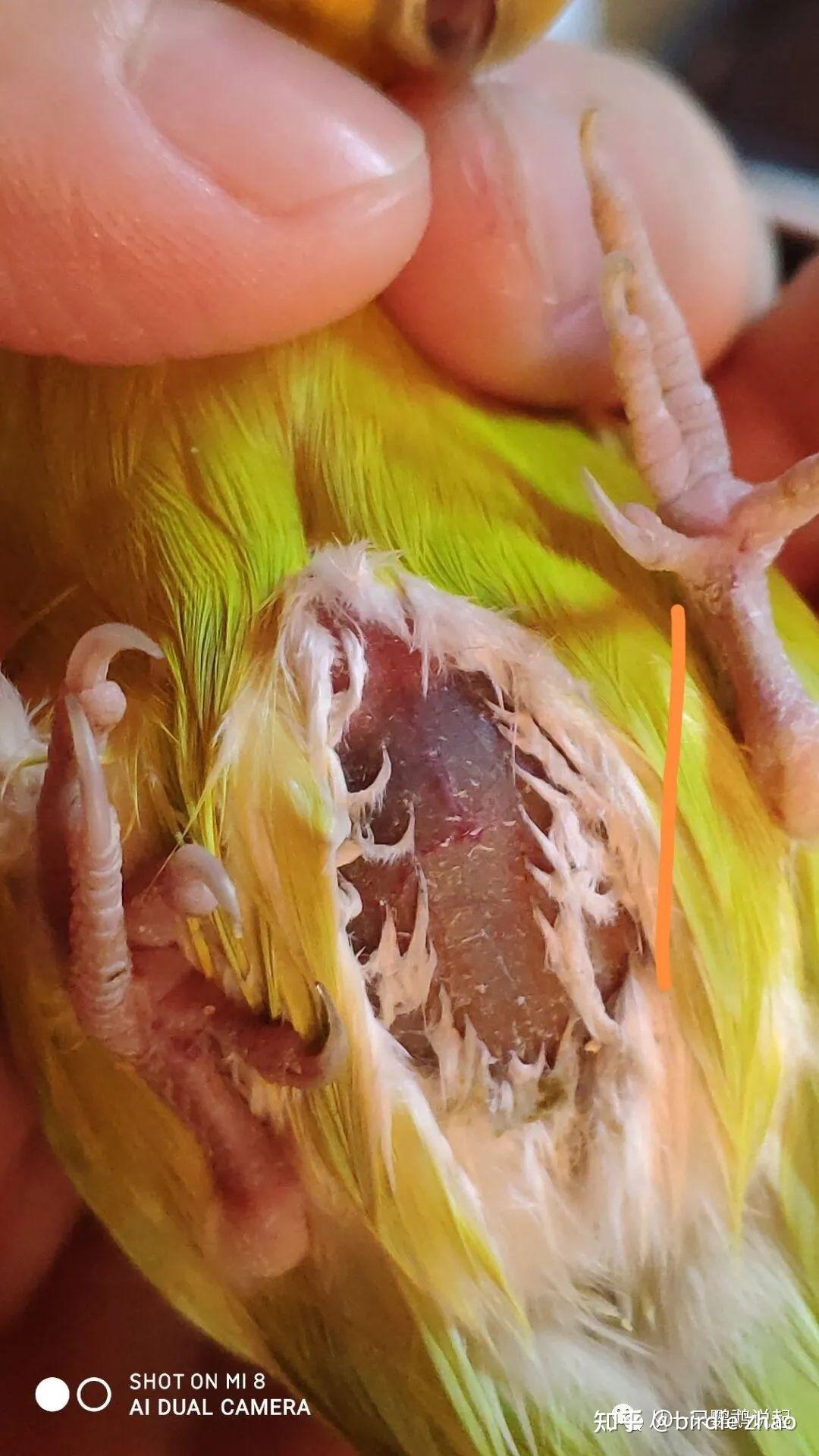 腹水——病例分析(3)