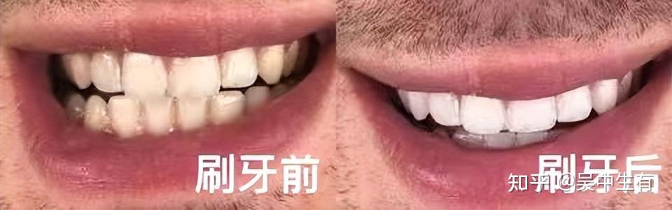 30天深度试用徕芬扫振电动牙刷真能精准还原巴氏刷牙