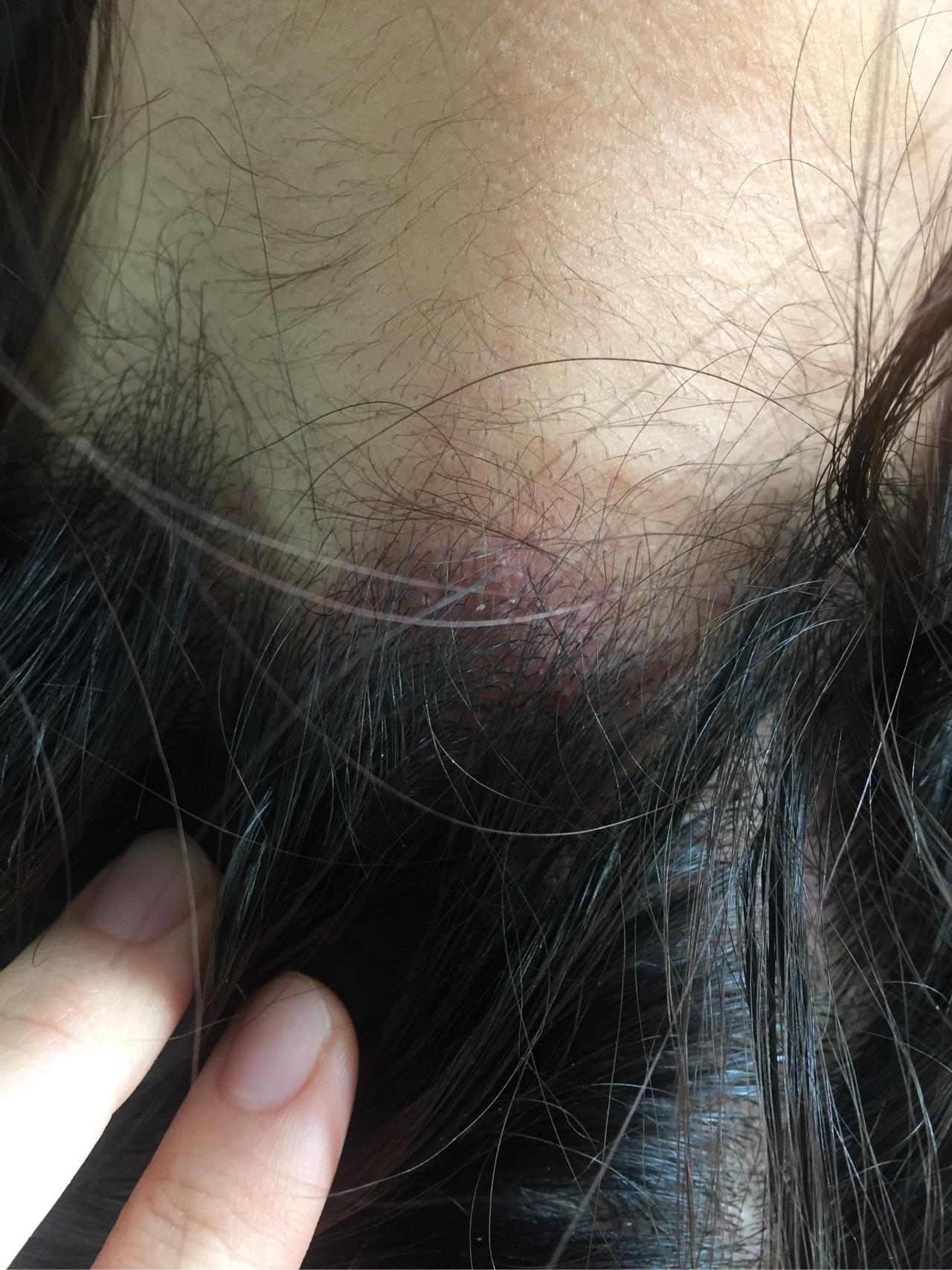 头皮上脂溢性皮炎和毛囊炎共生,多年,你们有根治的么?一起交流一下吧?