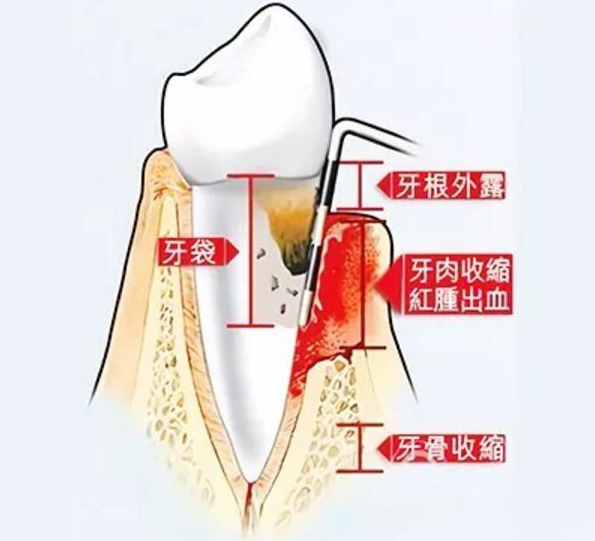 牙周炎主要有这5种表现,你都了解吗?看看医生的真心分享! - 知乎