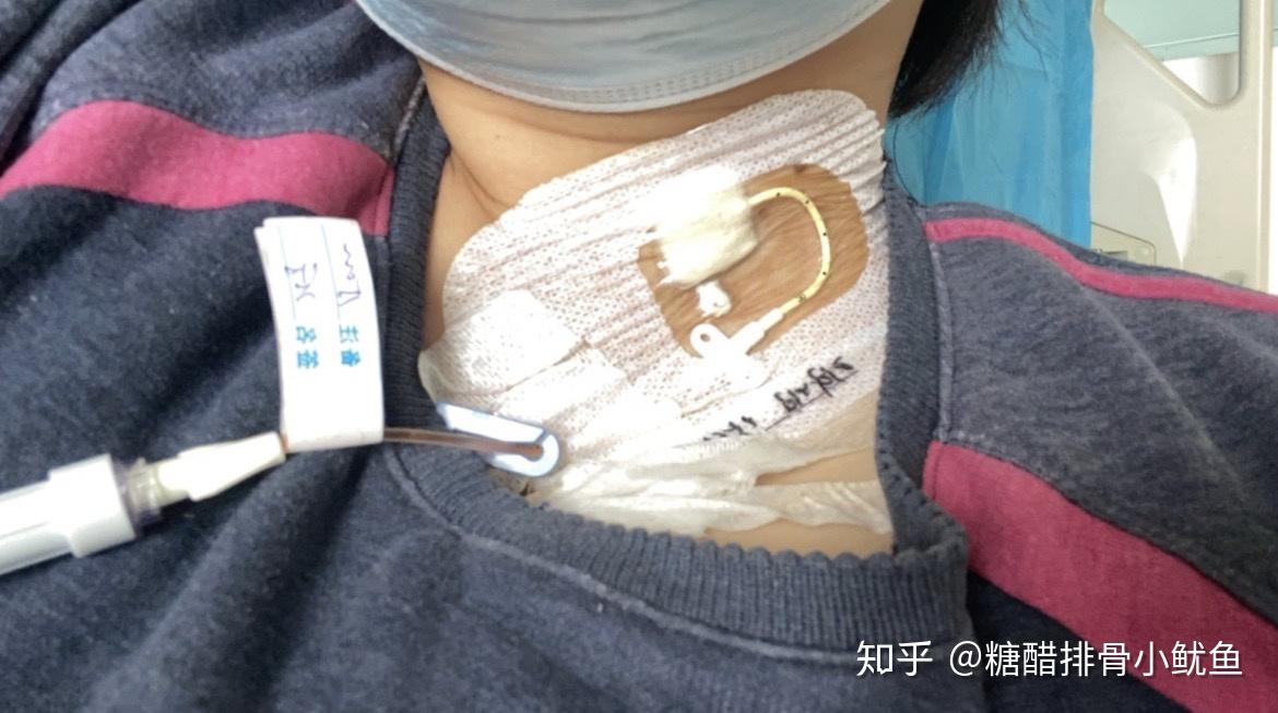 picc我用不了,每次去医院化疗医生都给我在脖子上埋管,这个名称叫什么
