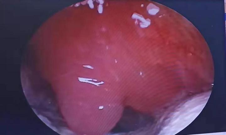 北京首大石萍扁桃体周围脓肿形成前和形成后的治疗
