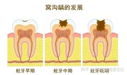 牙齿窝沟龋的发展主要有三个阶段 