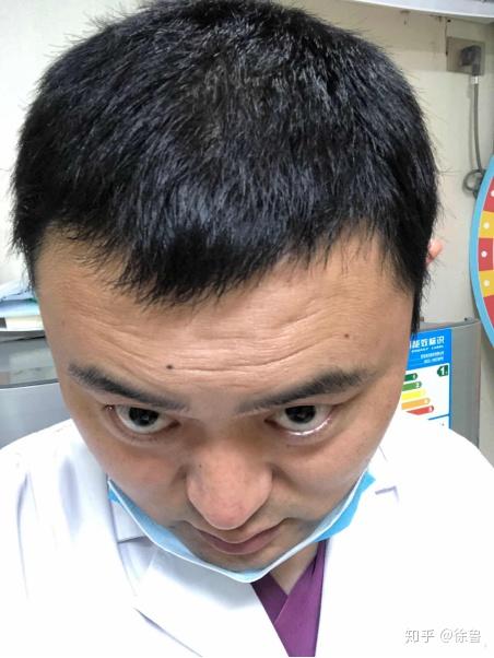 发际线高且m型发际线的男人适合什么发型额头较大