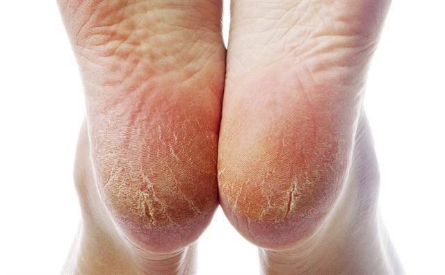 秋冬季节脚部干燥裂口处理小技巧