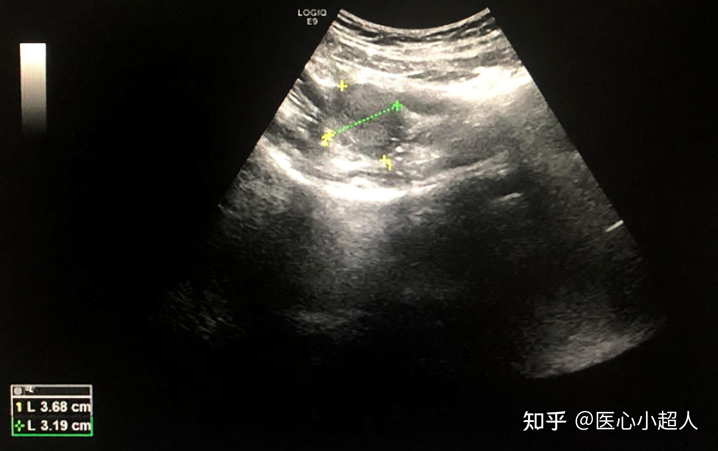 寶寶說不出苦！3歲童罕見卵巢畸胎瘤扭轉 手術切除保留卵巢功能 - 亞洲大學附屬醫院