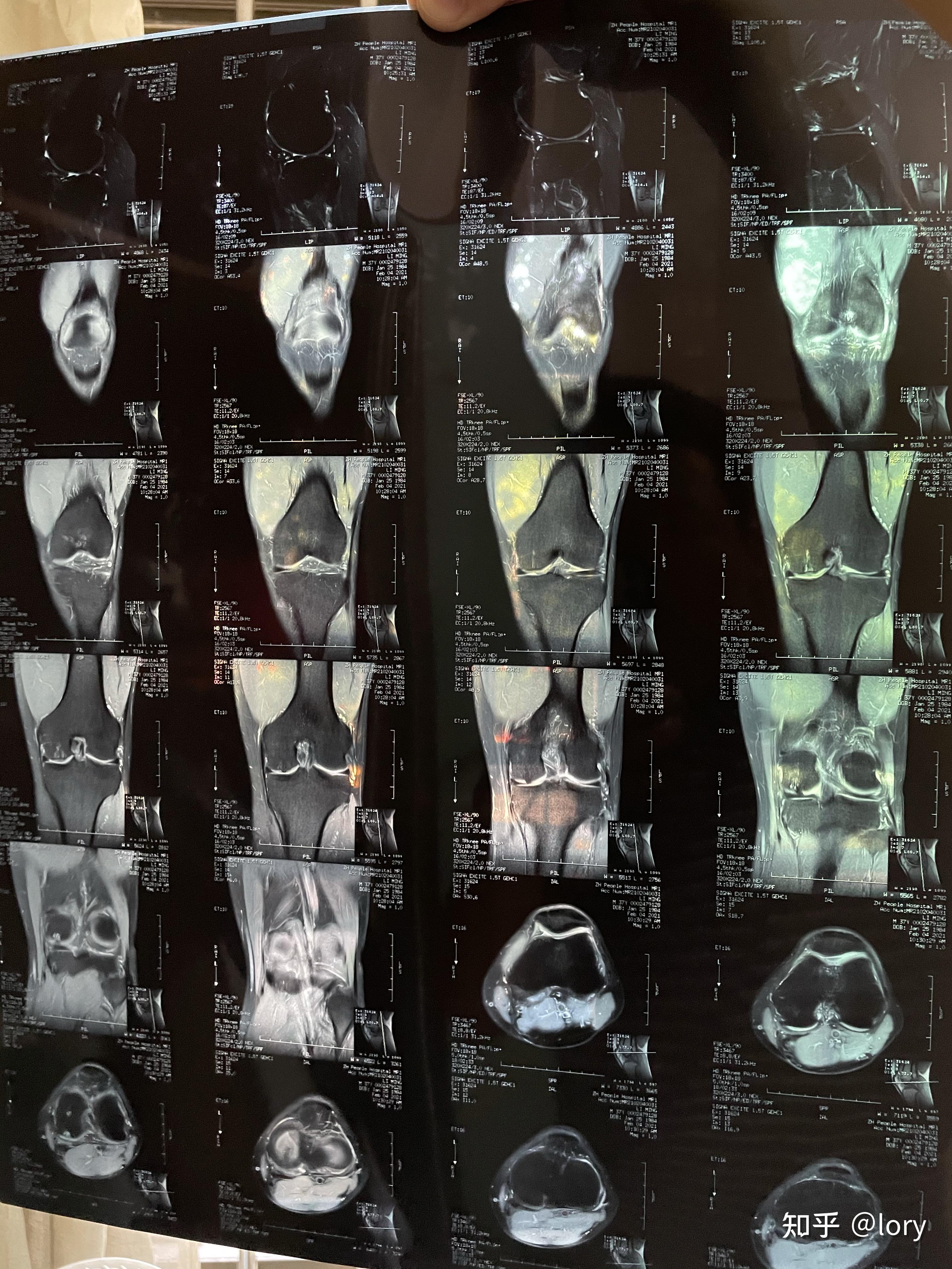 膝盖及腰椎伤病核磁共振结论篮球运动