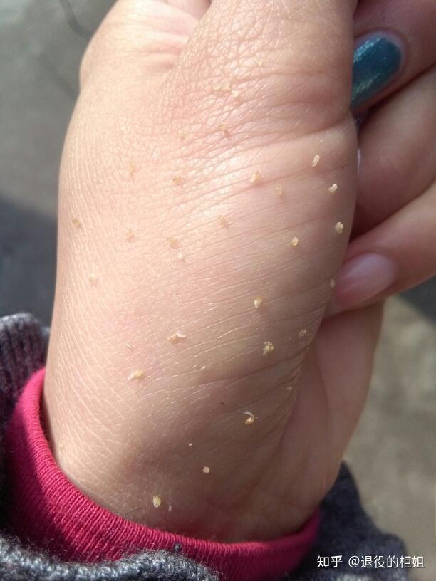 这时候再挤出来的,就是一颗颗的油脂颗粒了:一样的东西,其实就是油脂