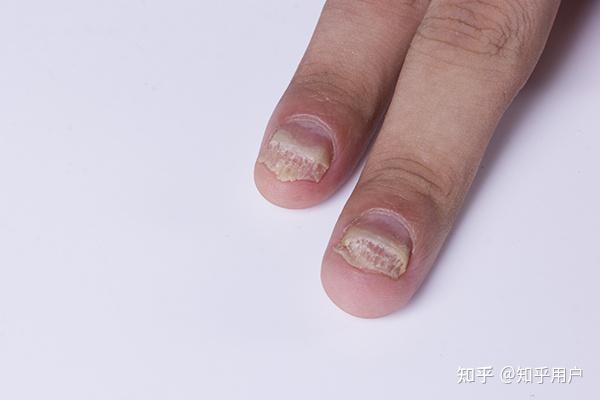 美甲美出灰指甲难以入目康复者自曝治疗经历一个小妙招指甲焕然一新