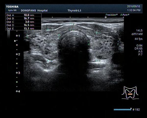 上图是桥本甲状腺炎的超声图像,双侧腺体内可见多发散在的低回声浇谮