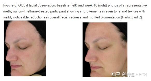 合理看待美白丸产品 皮肤的基础健康 90 的人被误导 它太重要了 知乎 合理看待美白丸产品 皮肤的基础健康 90 的人被误导 它太重要了 知乎