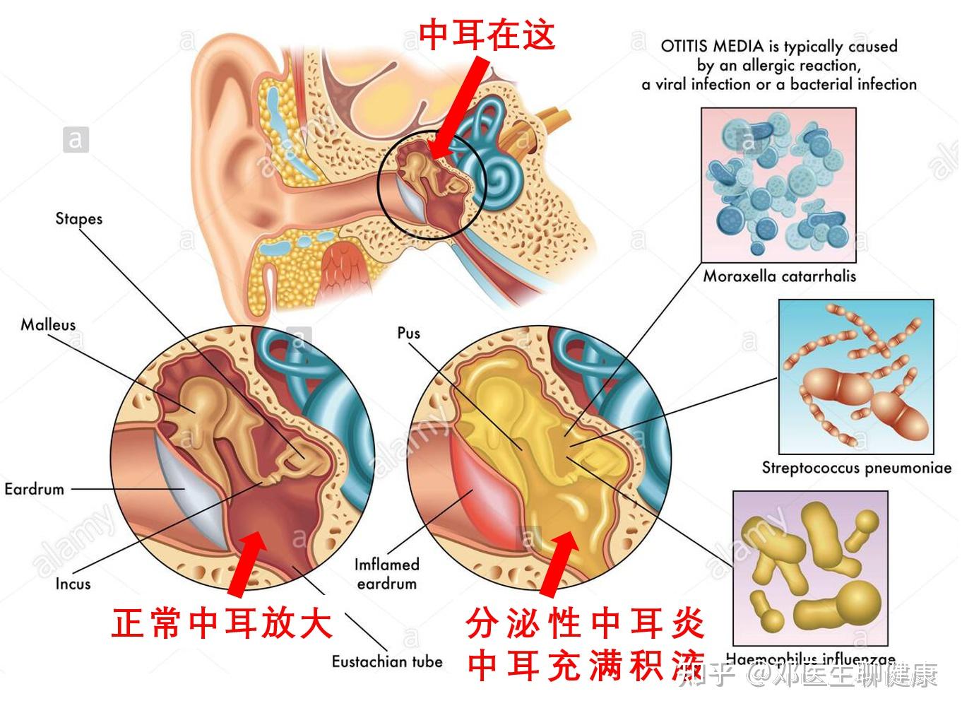 中耳炎是怎么引起的图片