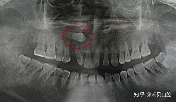 埋伏牙和阻生牙一定要拔吗? - 知乎