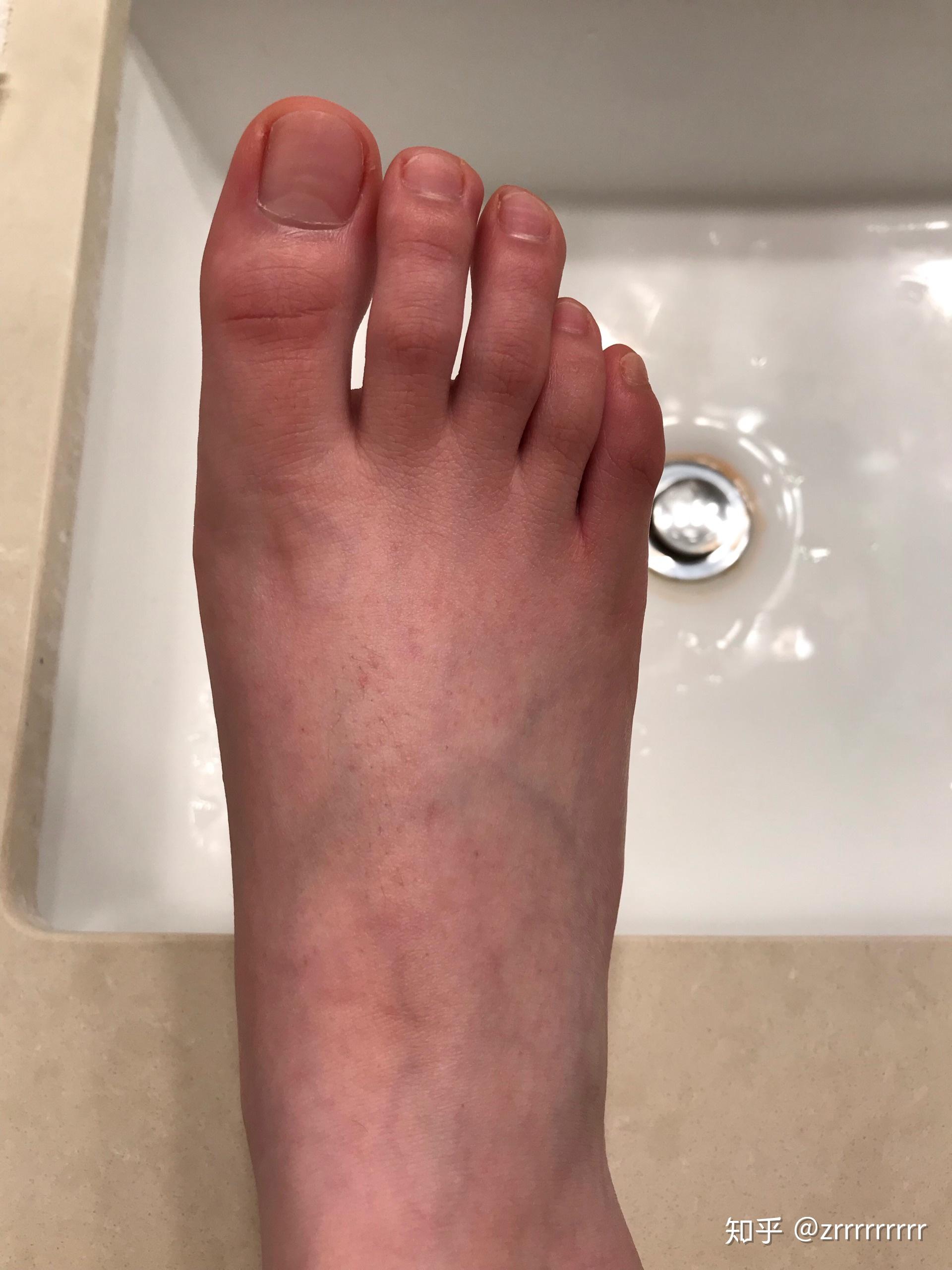 请问有人是第四脚趾短小症吗