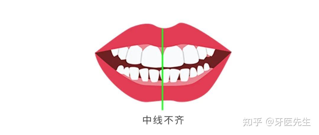 【Mr.Dentist牙医先生】如何判断嘴凸,是骨性还是牙性? - 知乎