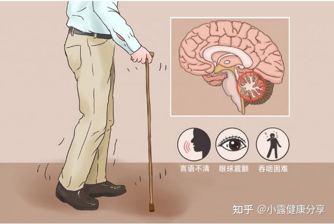 等典型共同症狀,以及伴眼肌麻痺,錐體外系症狀及視網膜色素變性等表現