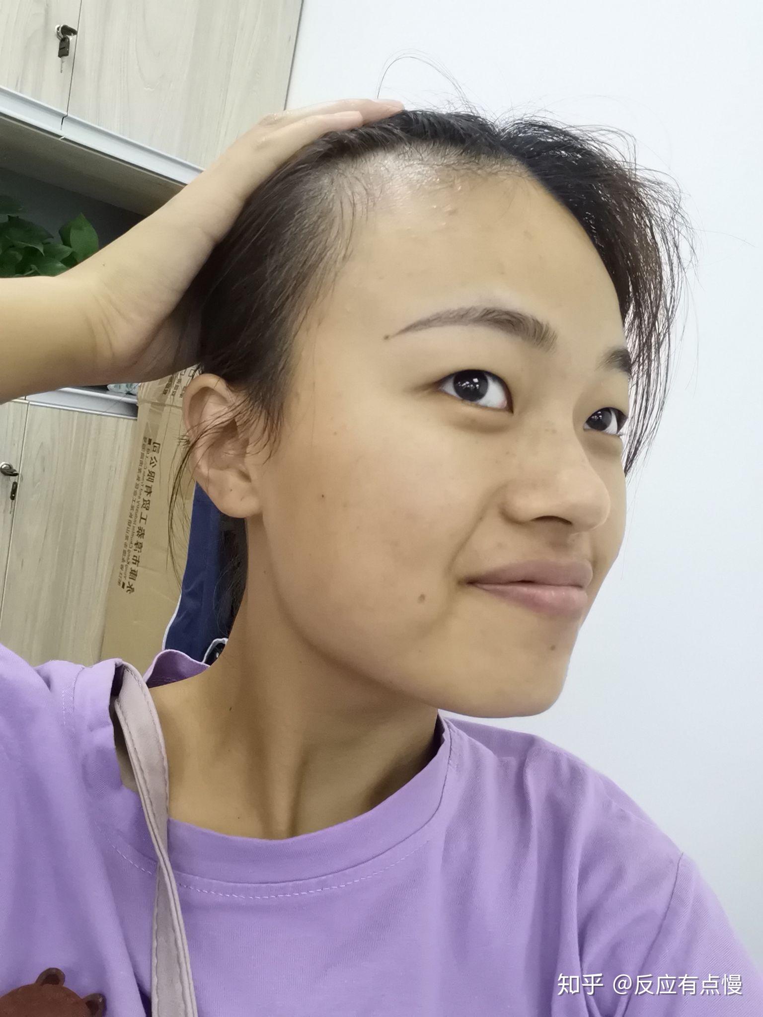 发际线太高是什么样的体验? - 知乎