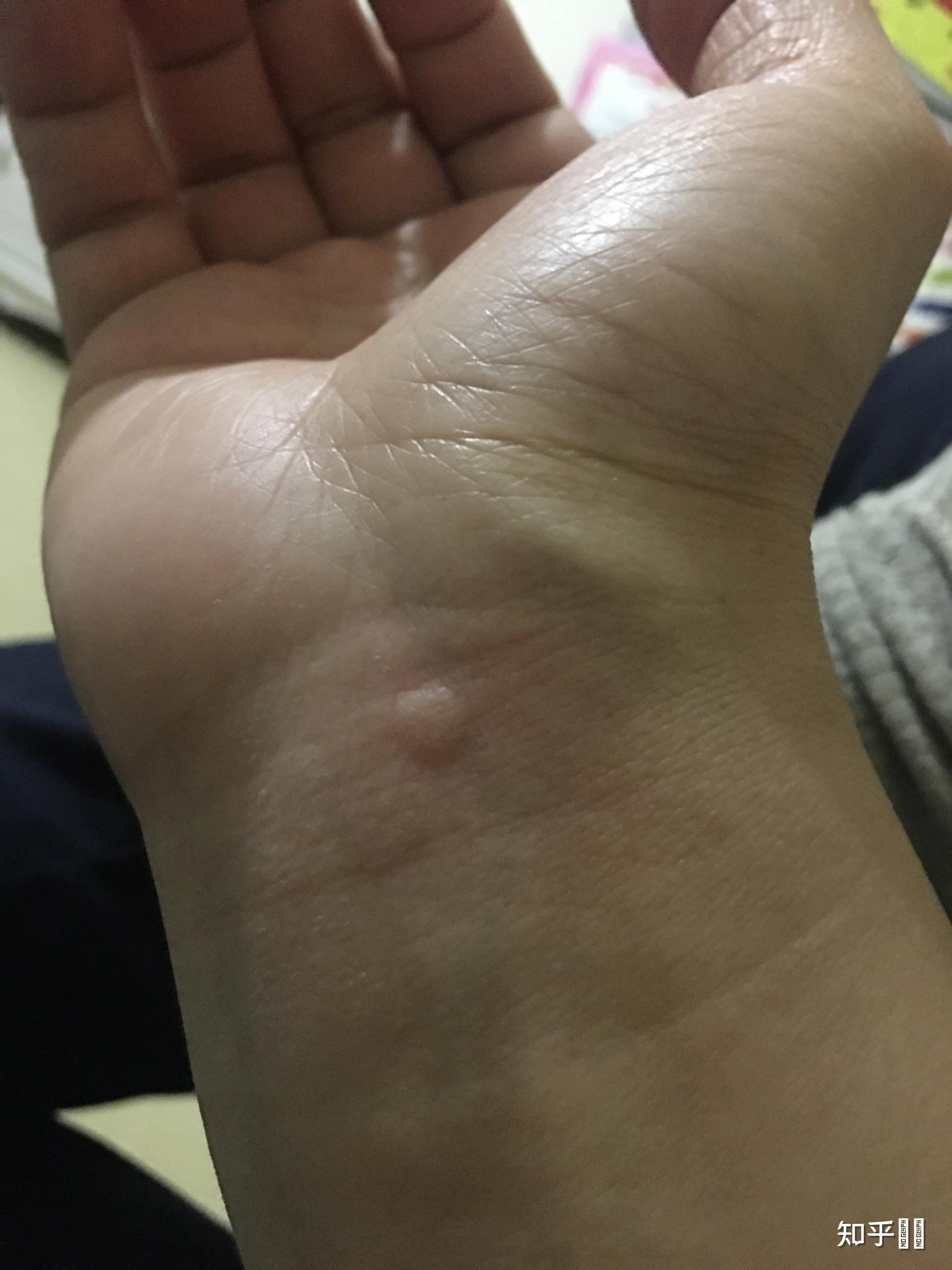 为什么在手腕背面总在一个位置上长类似于蚊子咬的包? - 知乎