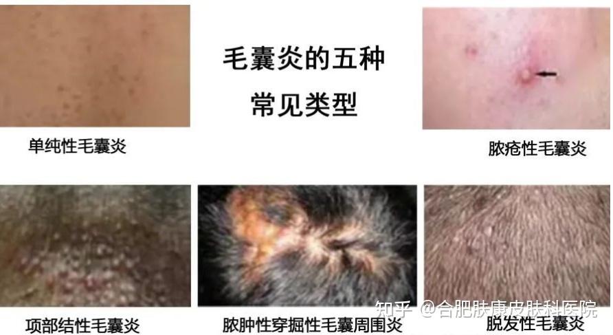 毛囊炎的五大类型,快来对号入座! - 知乎