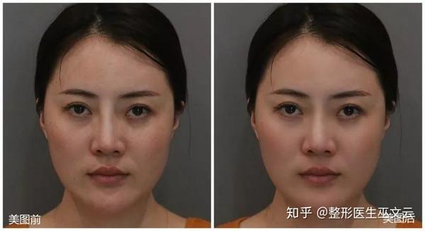 l型硅胶假体隆鼻后变通天鼻,该怎么办?