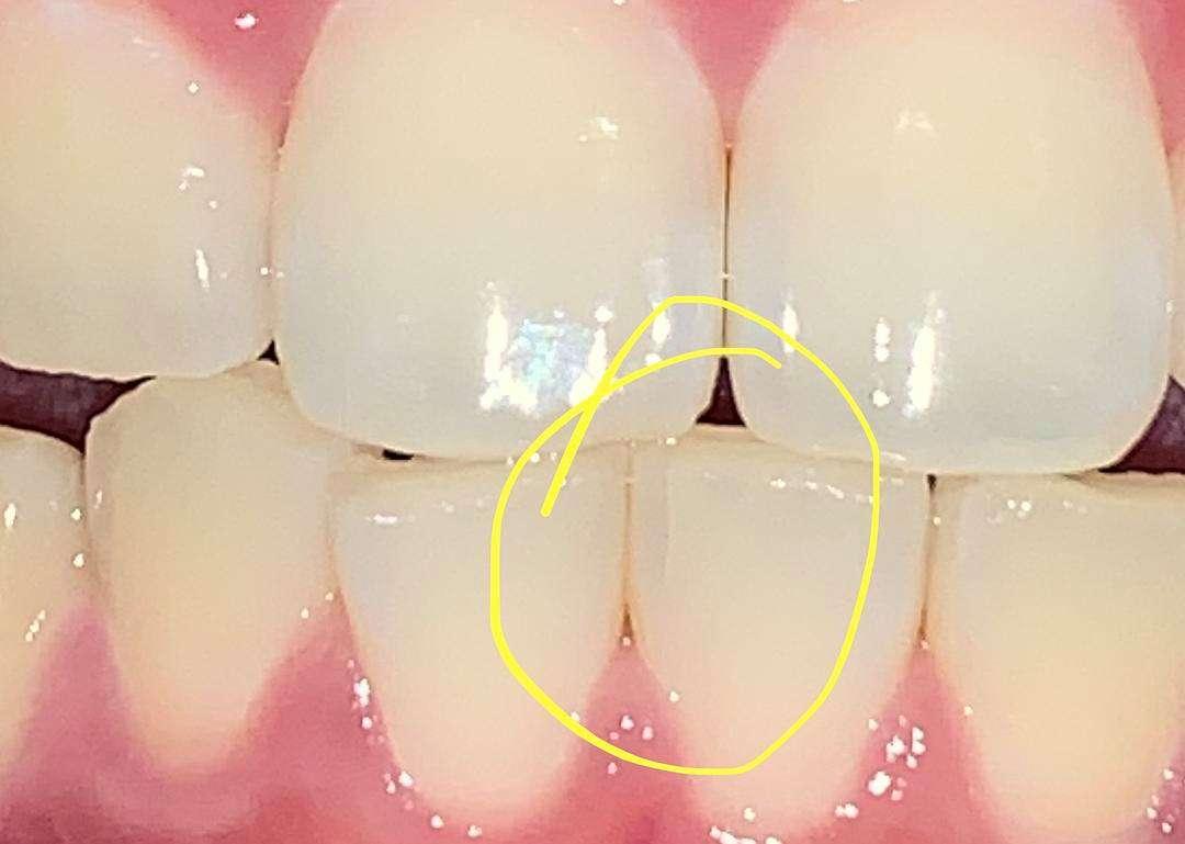 牙齒咬起來有點痛的---牙齒裂了 - 案例介紹 - 美容牙科張凱榮醫師
