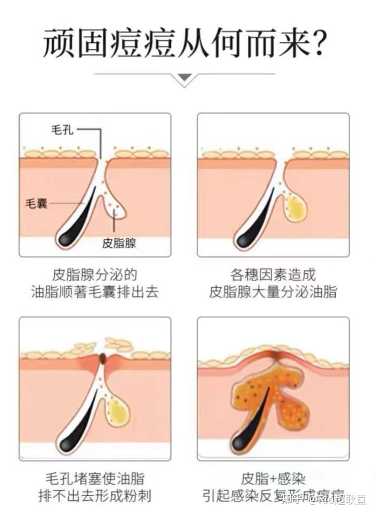 超耿直推荐一个控油祛痘的宝藏护肤品牌——FreeSkin - 知乎