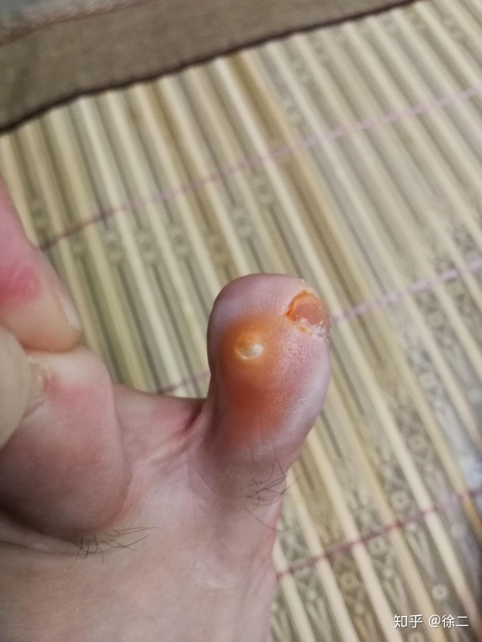 你是如何治好脚上长的鸡眼的