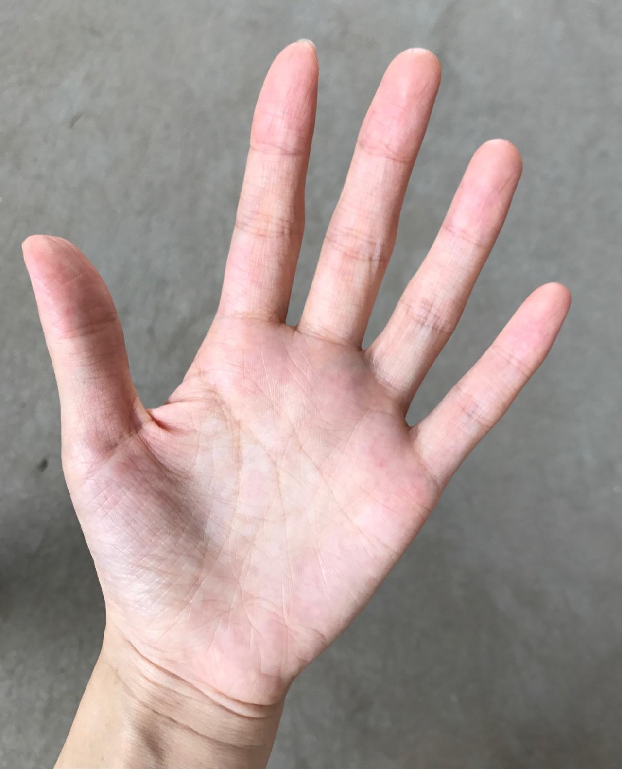 生产后手指尖干瘪长竖纹怎么回事?有办法治疗吗? - 知乎