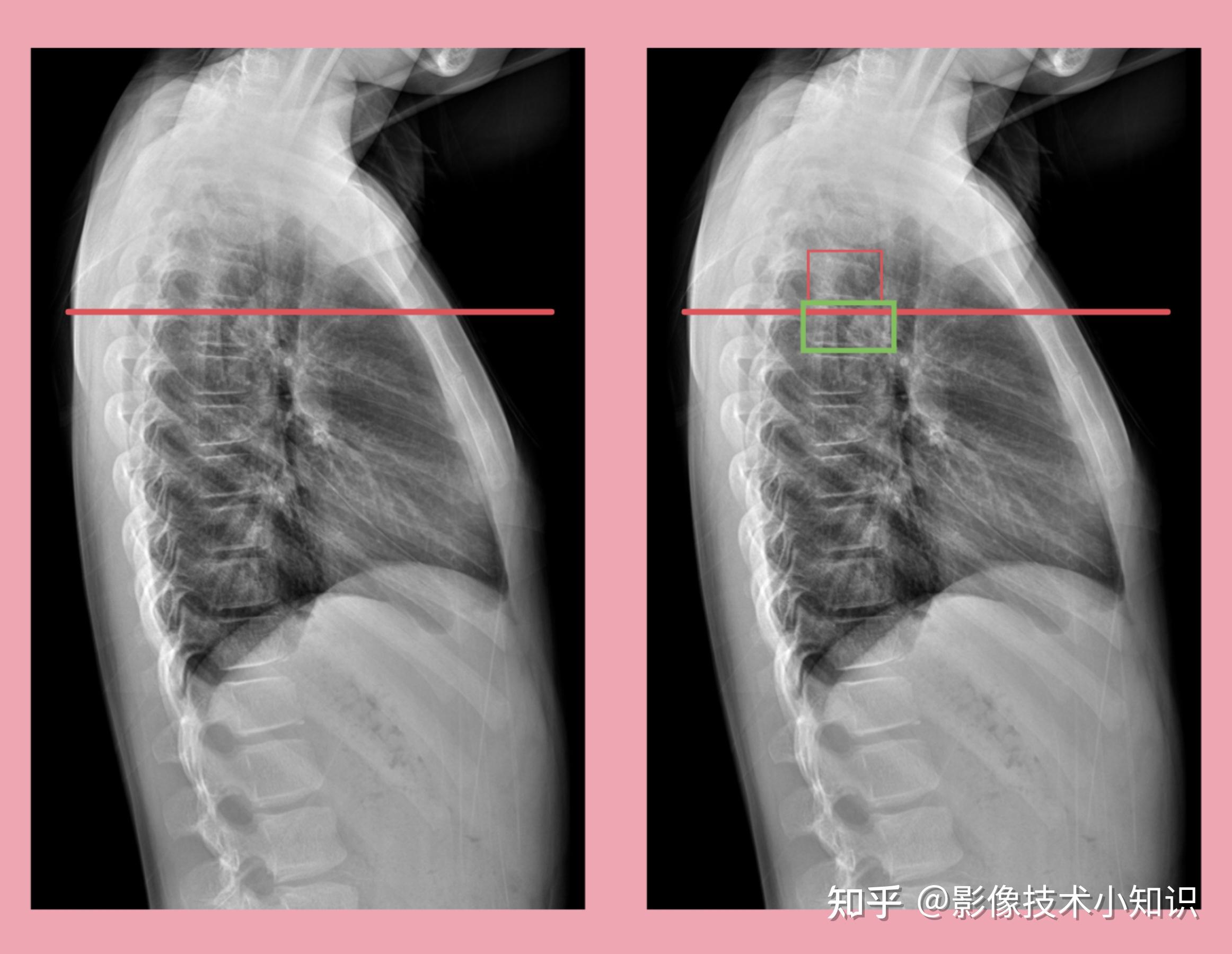 胸椎x线解剖图图片