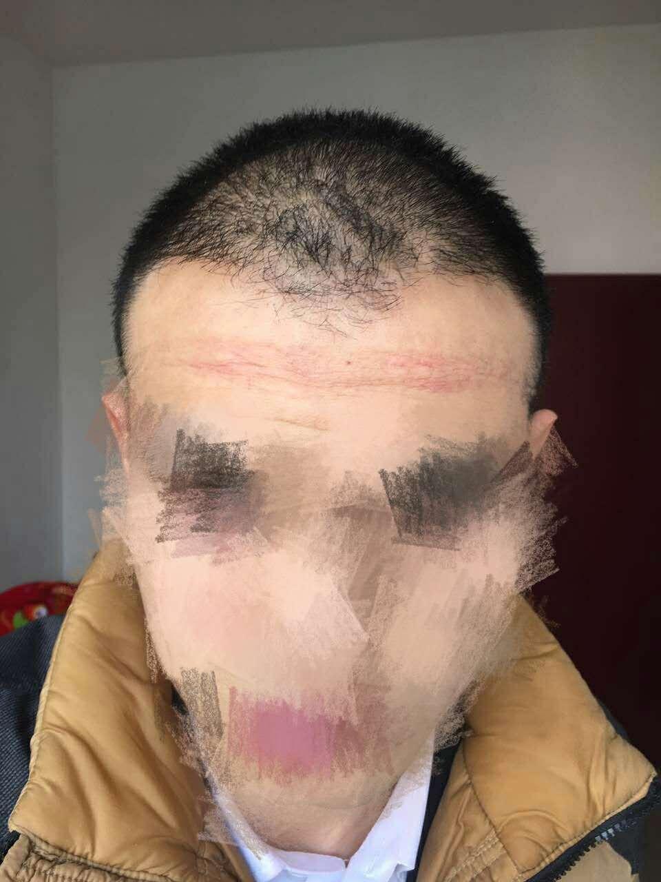 对于植发成活率的怀疑? - 逆流的回答