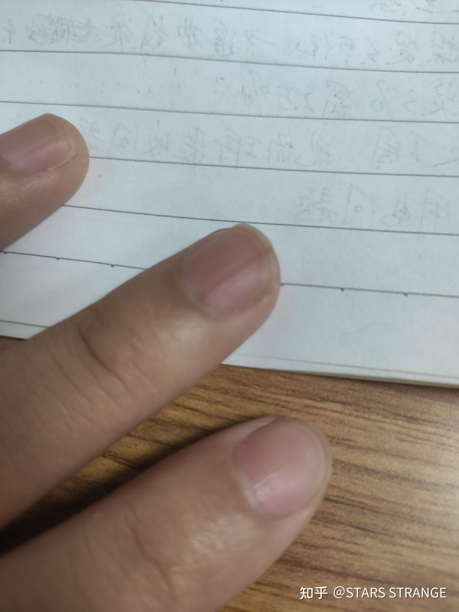 左手大拇指指甲有一条淡褐色竖线好几年了微量元素也正常为什么啊
