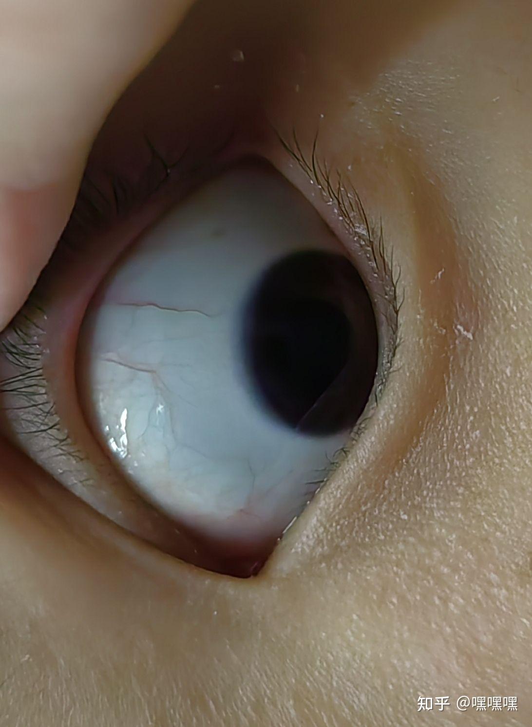 为什么眼白中有些黑色斑块? - 知乎
