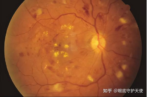 眼底病|眼睛黄斑病变有什么影响?不治疗会失明吗? - 知乎
