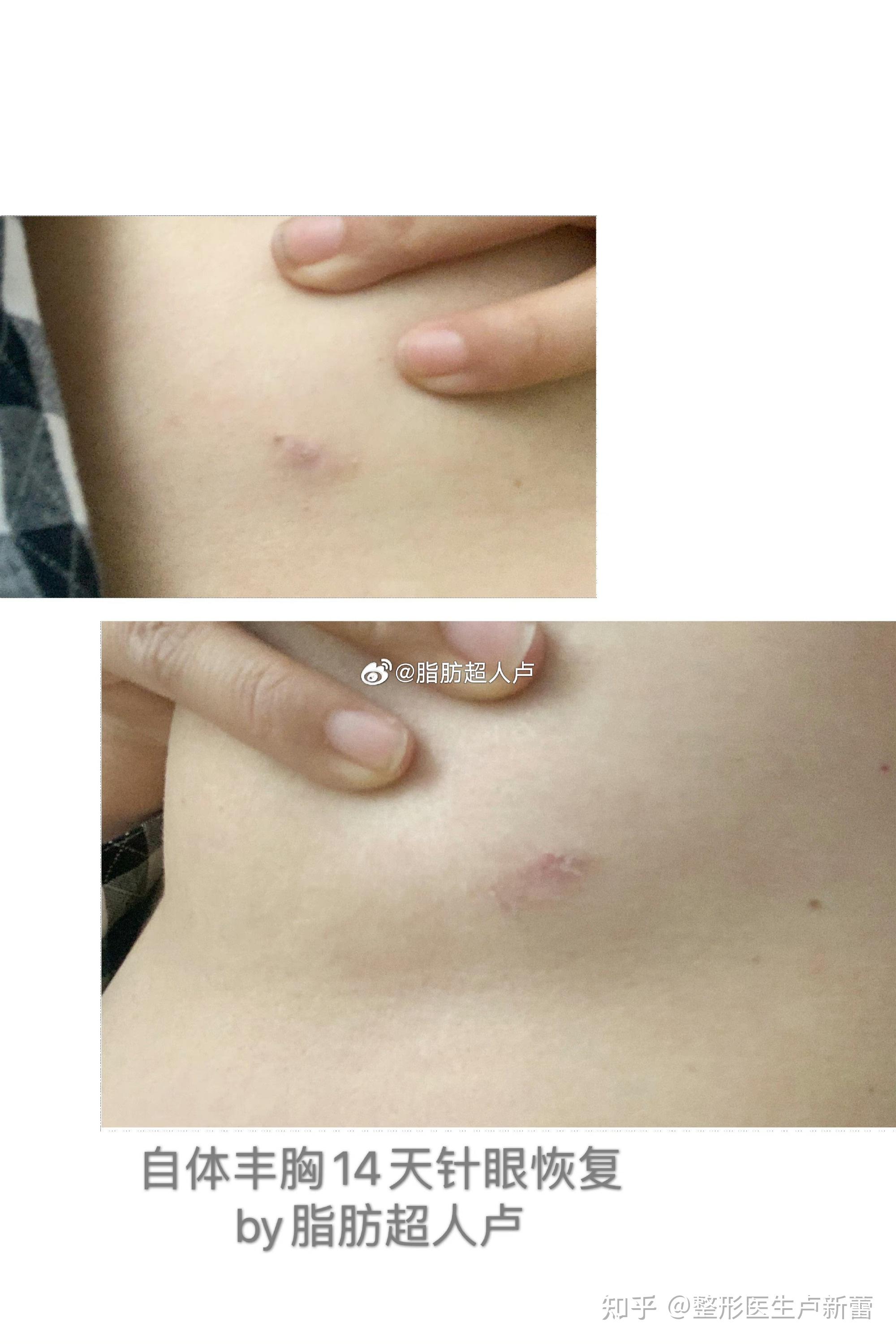 自体脂肪隆胸的疤痕在什么位置?明显吗?