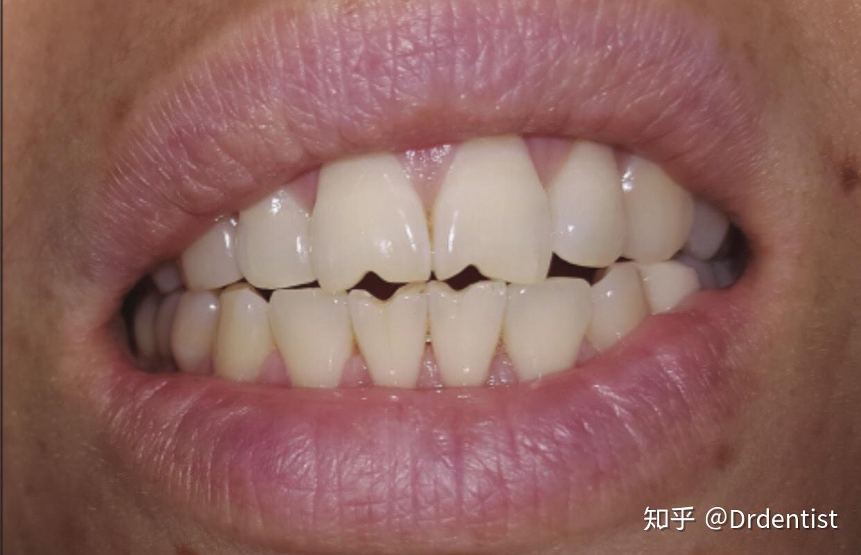 磕瓜子对牙齿有损害吗?为什么? - 知乎