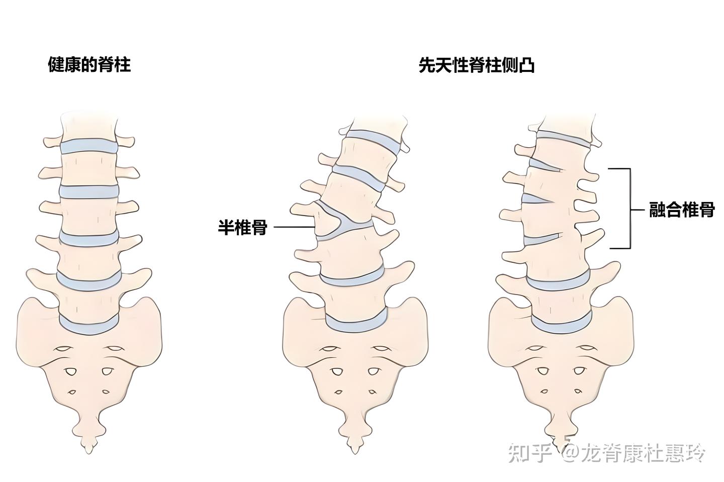 先天性脊柱侧弯患者,积极戴支具及训练1年,剃刀背基本恢复正常 - 知乎