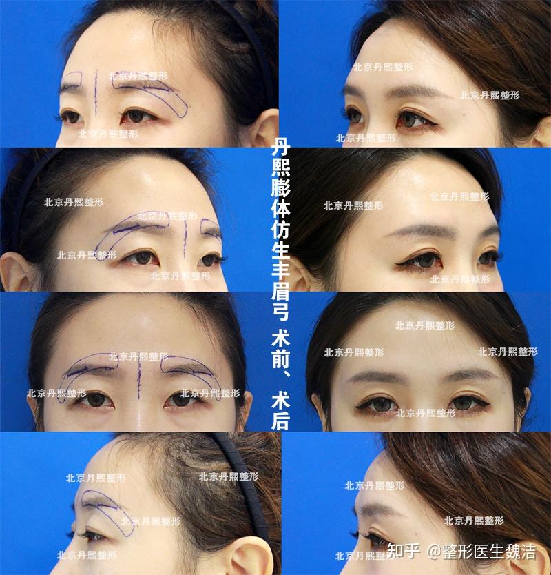 膨体丰眉弓—整形教材及整形会议中未提及的手术 - 知乎