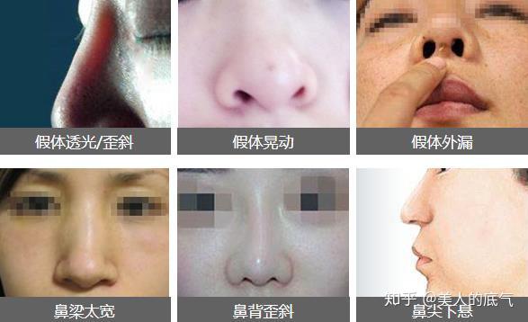 韩国哪家整形医院比较擅长做高难度鼻修复手术 知乎