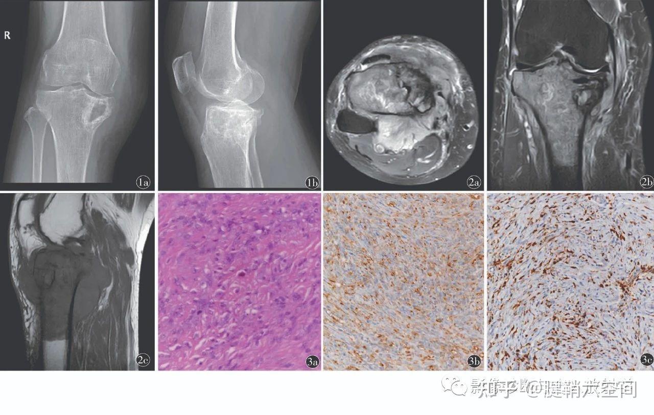 腱鞘巨细胞瘤病理图片