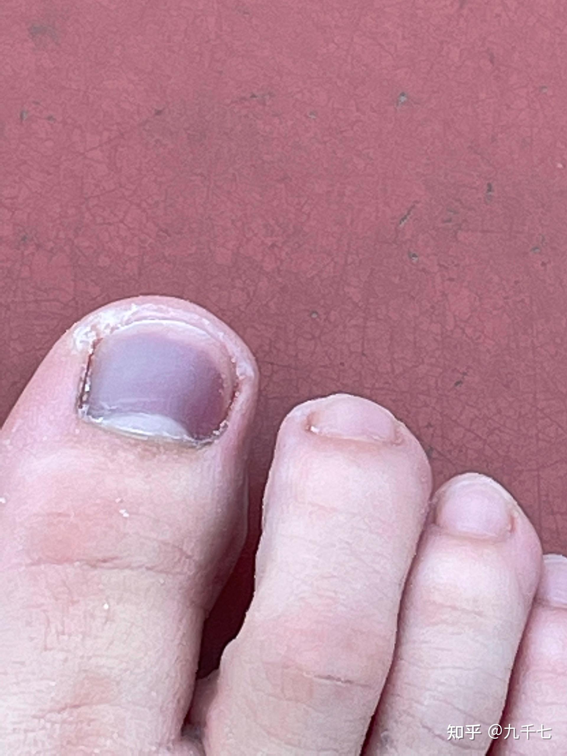 打篮球脚趾甲里面有淤血? - 知乎