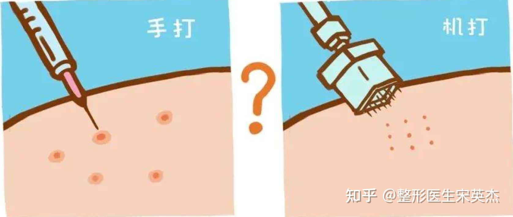 八,打水光针选择机打还是手打?