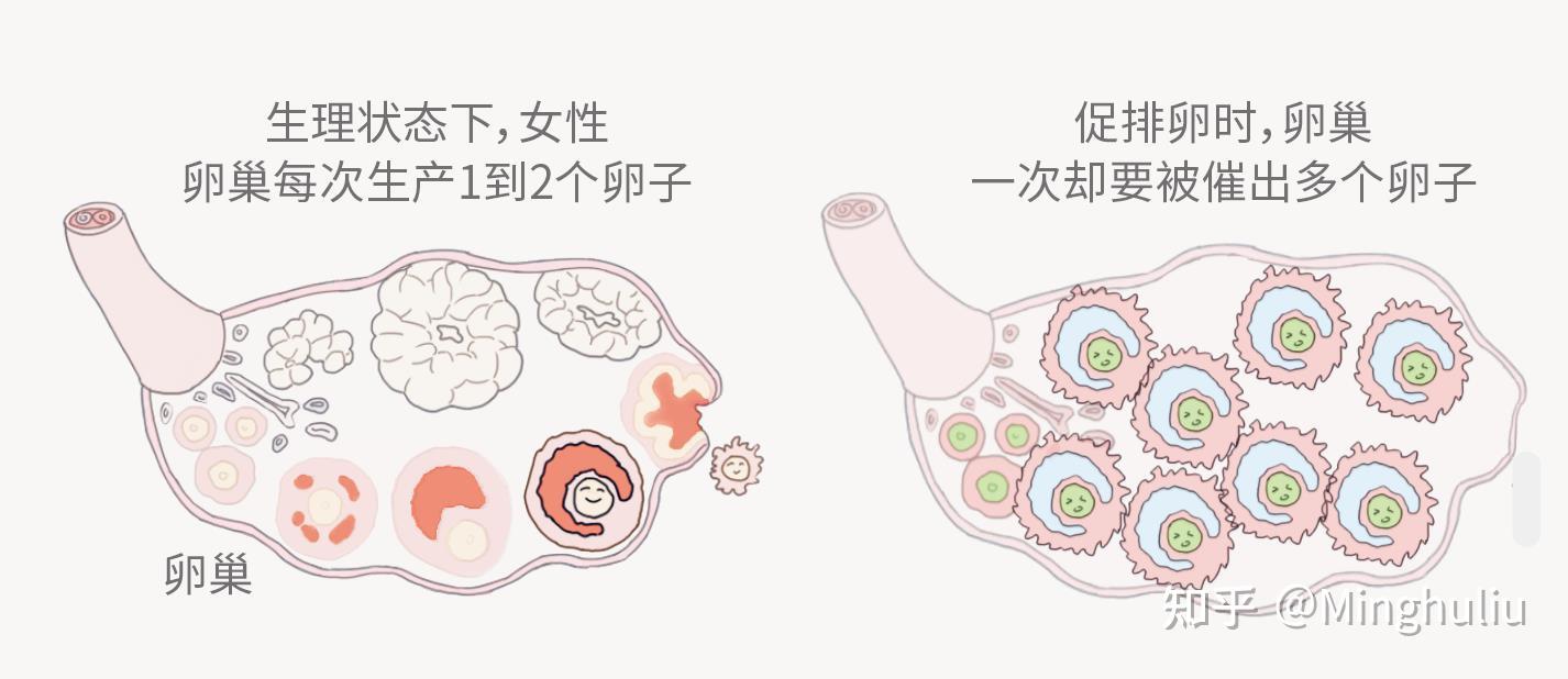 卵子提取过程可能会发生感染