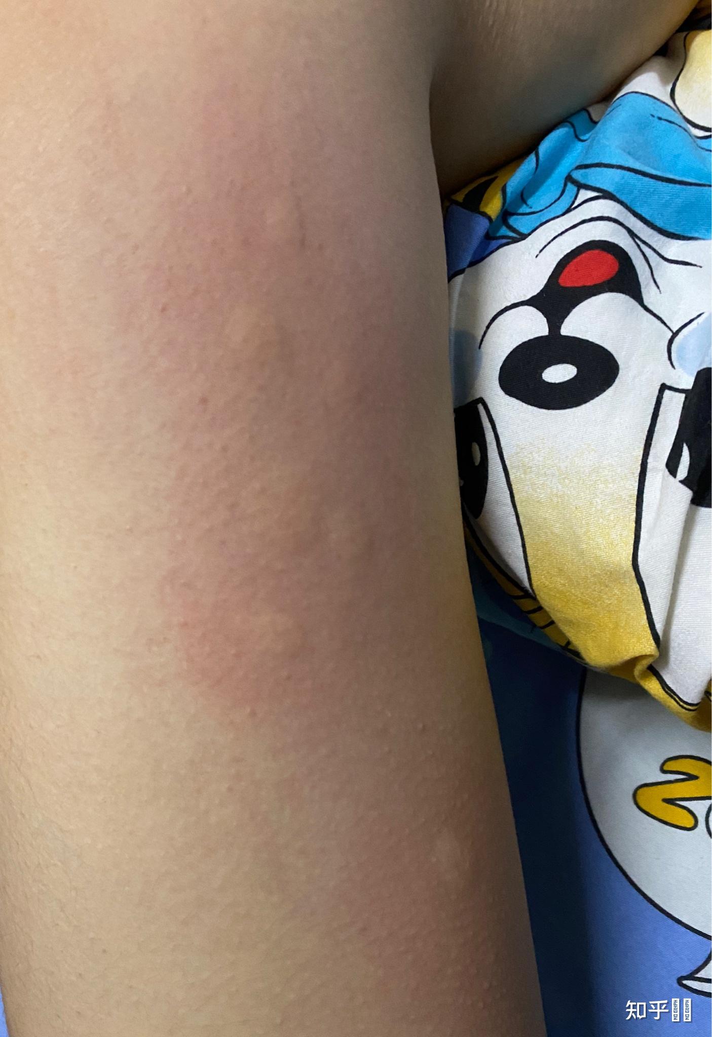 身上出现像蚊子咬的包,是什么咬的啊?