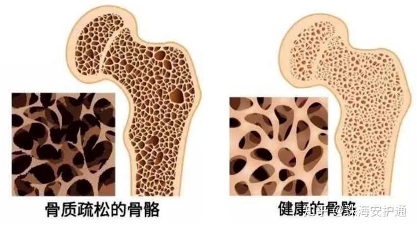 【小安陪护课堂第二十五期】关于老年人骨质疏松症的预防小知识! - 知乎