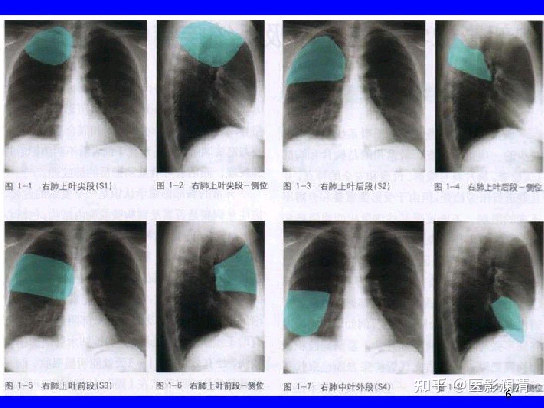 肺部五叶十八段在CT上怎么具体划分呢？mimics做三维重建的话，以什么标准执行呢？ - 知乎