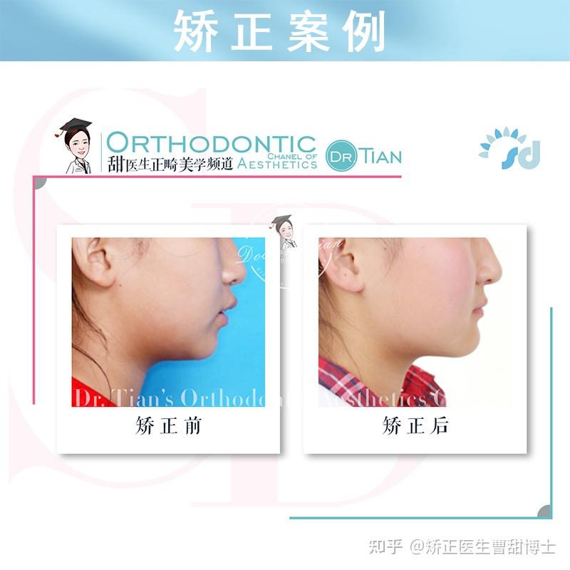 牙齿矫正拔 4 号牙和 5 号牙有什么区别? - 知乎